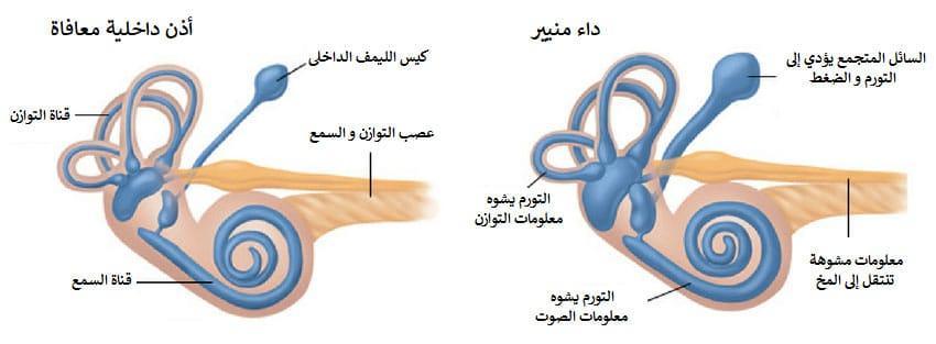 داء منيير الاسباب، العلاج و الجراحة 1 داء منيير الاسباب، العلاج و الجراحة 1