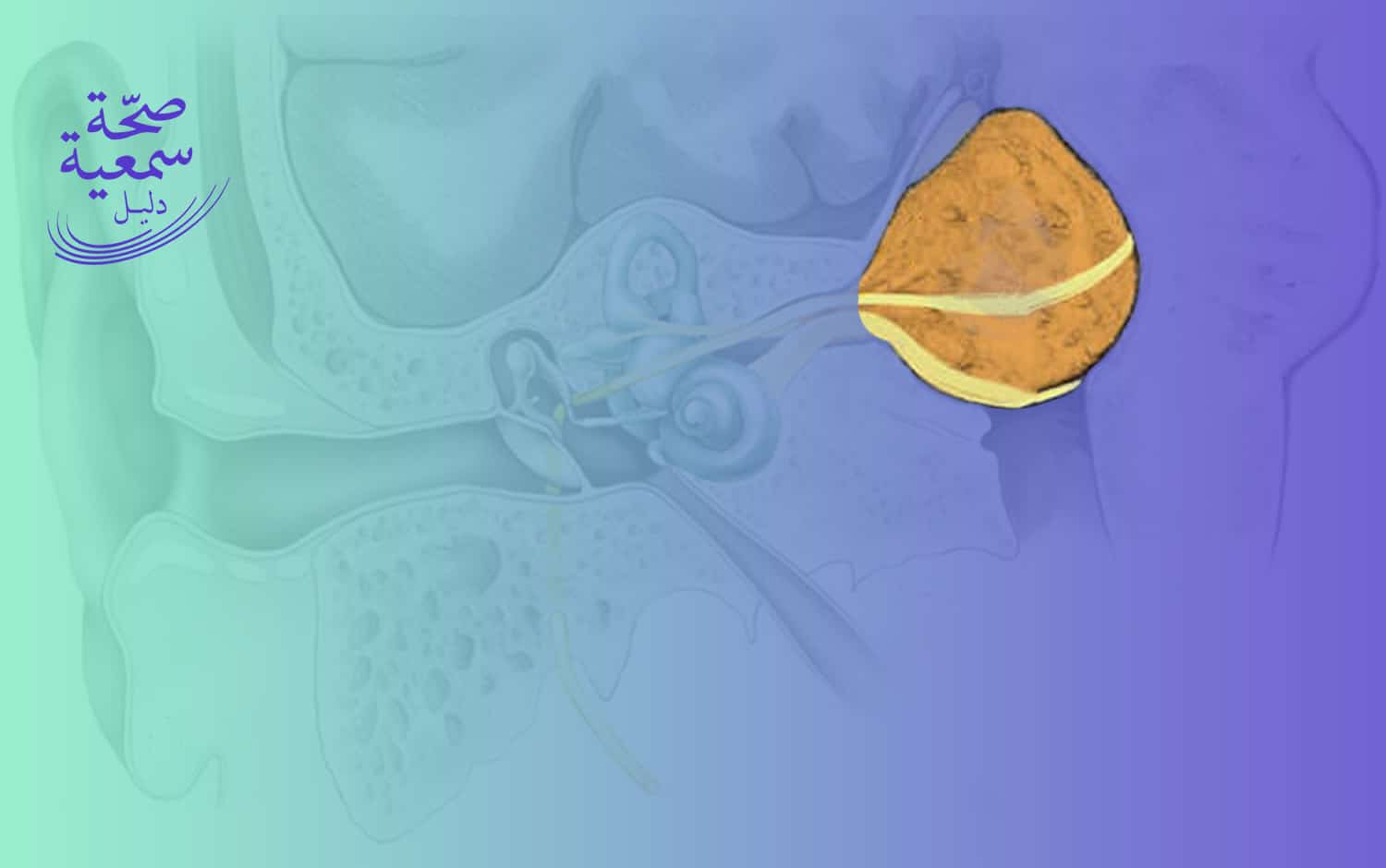 ورم العصب السمعي