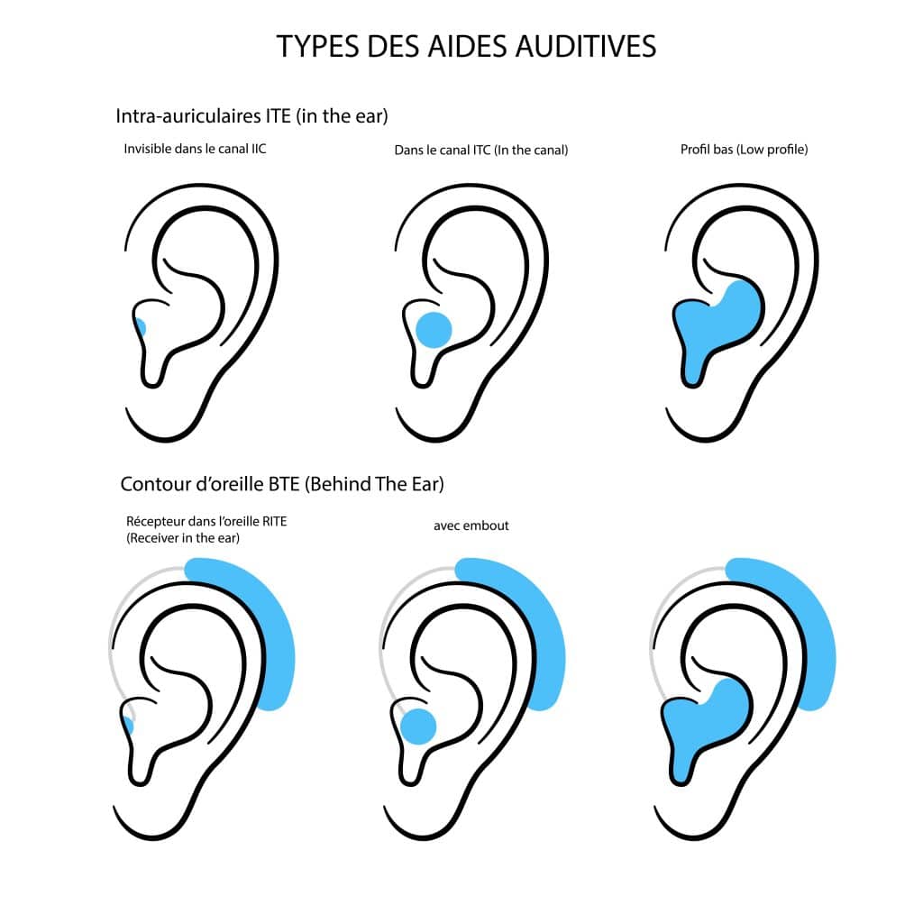 types aides auditives