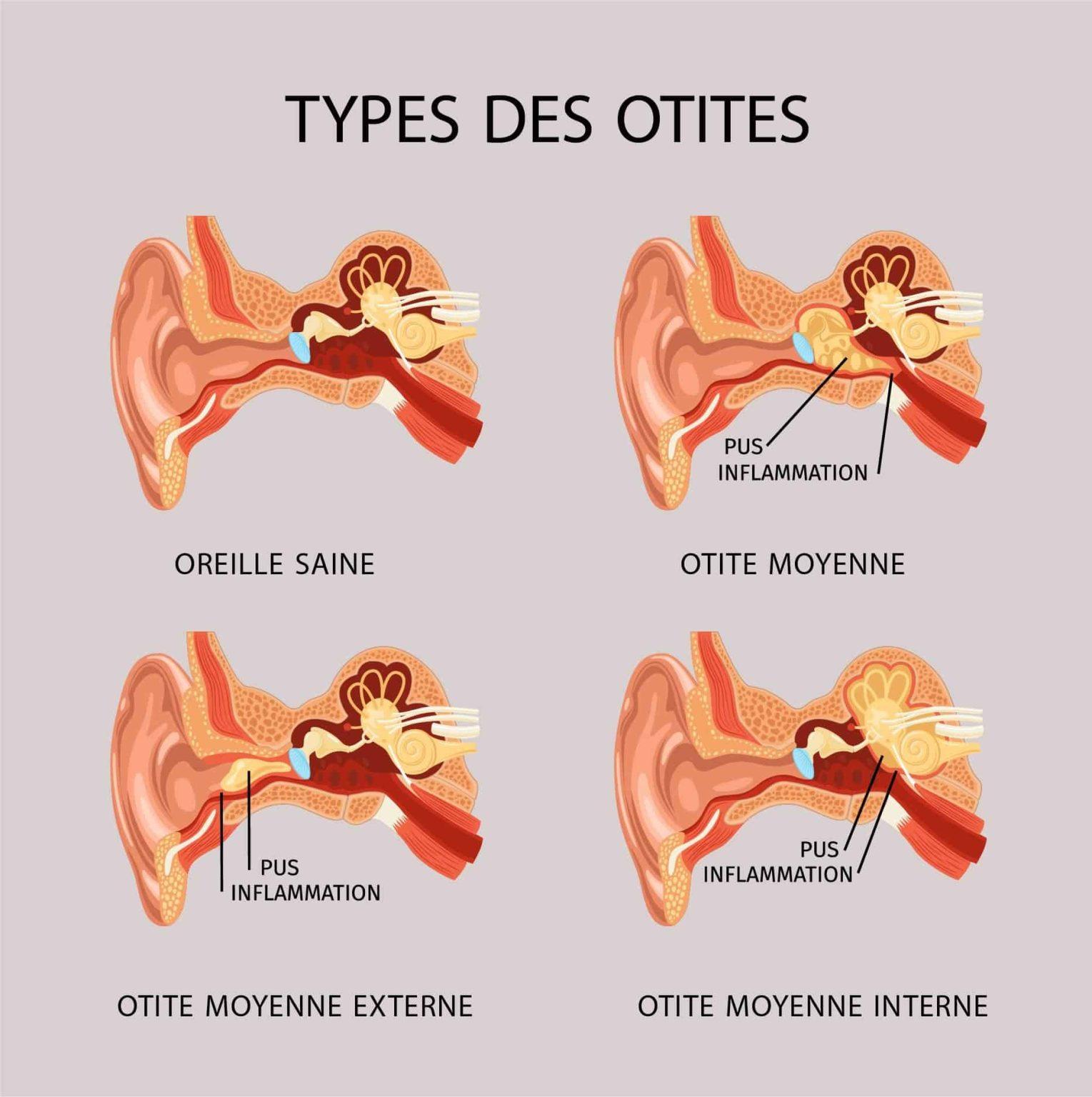 Otite Causes Sympt mes Traitements Et Conseils Pour Prot ger Votre Otite Causes Sympt mes Traitements Et Conseils Pour Prot ger Votre
