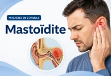 mastoidite